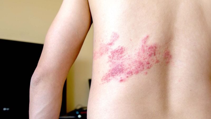 zona-xuat-hien-som-hoac-tai-phat-bat-thuong-co-the-la-mot-trong-nhung-trieu-chung-hiv