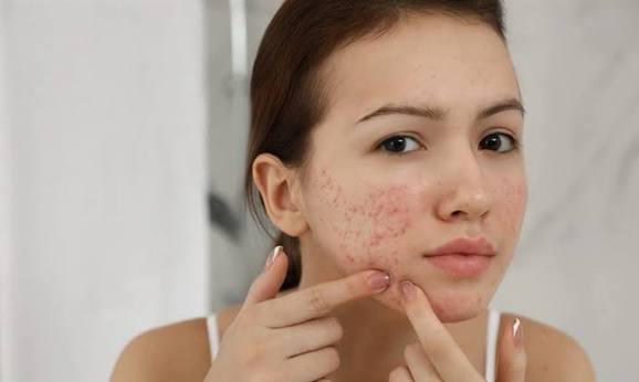 Bên cạnh các sản phẩm đặc trị, một số nguyên liệu thiên nhiên quen thuộc cũng có thể hỗ trợ làm dịu da, cải thiện sắc tố và thúc đẩy quá trình phục hồi khi được sử dụng đúng cách.