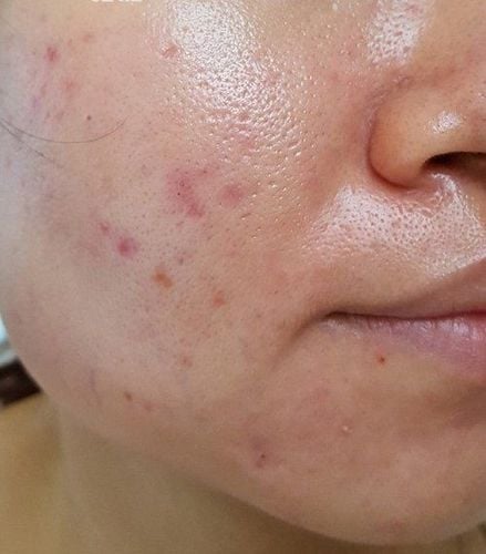 Làm sạch là bước nền tảng trong quá trình chăm sóc da dầu. 