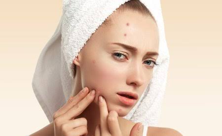 Nhiều người có thói quen tự xử lý mụn ngay khi thấy xuất hiện nhân trắng hoặc cồi mụn. 