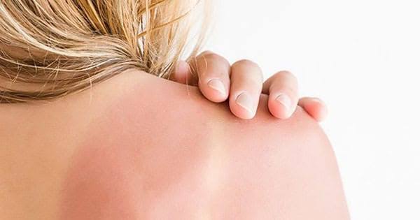 Nhiều người có thói quen dùng đá lạnh để giảm cảm giác bỏng rát nhưng đây lại không phải là lựa chọn phù hợp.    