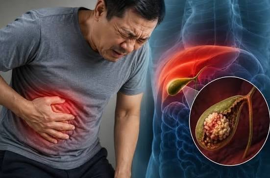 3 dấu hiệu cảnh báo viêm túi mật nặng