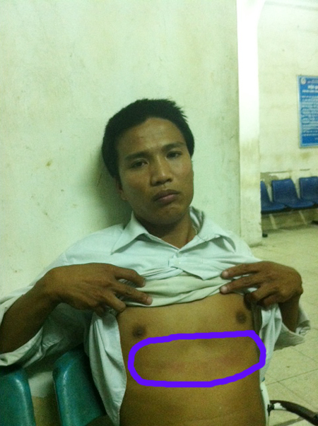 Anh Nguyễn Văn Trà với vết thương trên ngực