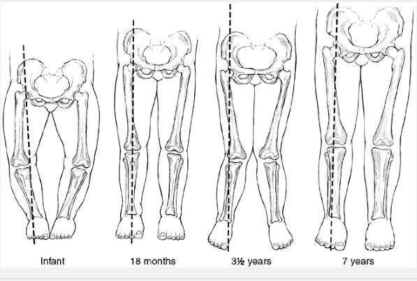 Cấu trúc xương là nguyên nhân chính trong việc gây ra chân vòng kiềng