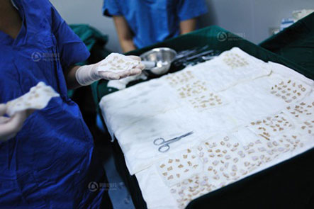 Bác sĩ phẫu thuật ghép nối những mảnh da sau khi lấy trên cơ thể hai người con trai (nguồn:Vtc.vn)