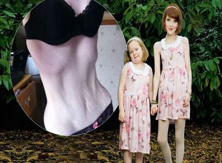 Hình ảnh bà mẹ Rebecca Jones mắc chứng rối loạn ăn uống bên hai cô con gái yêu.