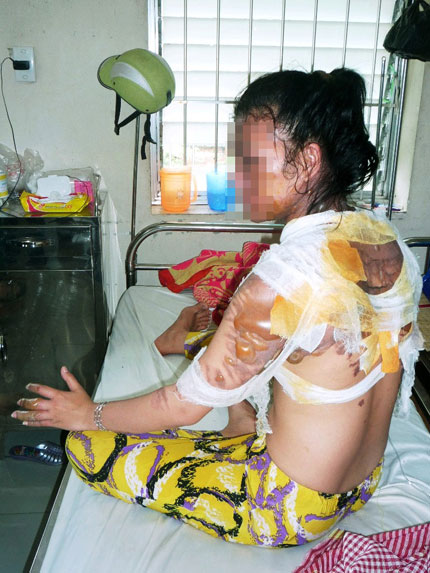 Chị Võ Mai Thy bị bỏng nặng do bị chồng bạo hành