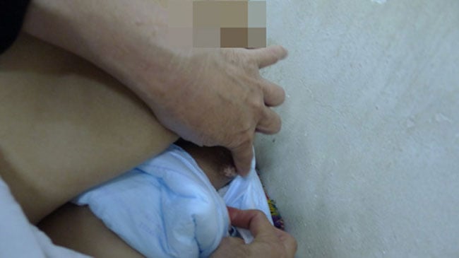 Ngồi quá lâu ở một tư thế, dưới hông sản phụ này bị sưng cục, phồng to như quả táo