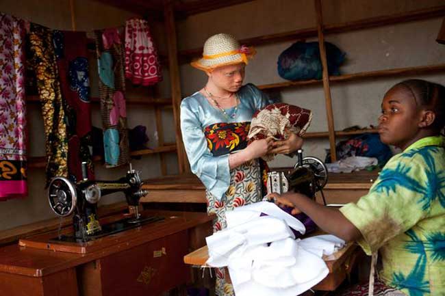 Ngoài nguy cơ bị săn bắt ngoài đường, những người bạch tạng ở quốc gia này còn phải bảo vệ bản thân trước ánh nắng vì nguy cơ ung thư da của họ rất cao. 98% số người bạch tạng bị chết là do nguyên nhân này.