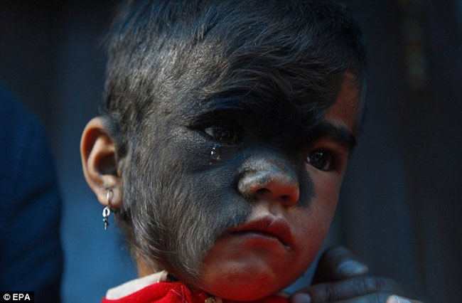 Bhana Thami sinh ra với một nửa gương mặt bị bao phủ bởi lớp lông đen, dầy khiến cô bé bị những người xung quanh gọi là quái vật, phù thủy do cô mắc căn bệnh nốt ruồi hiếm, căn bệnh mà không được chữa trị sẽ phát triển thành ung thư.