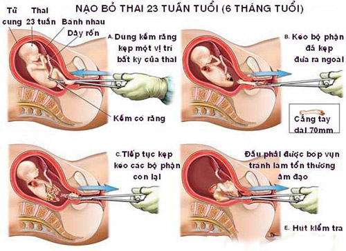 Nạo phá thai ở Việt Nam xếp thứ 5 thế giới