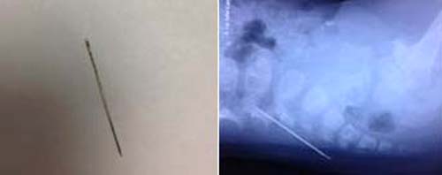 Chiếc kim khâu đã lấy ra và X-quang có hình ảnh kim khâu. Ảnh do bác sĩ cung cấp