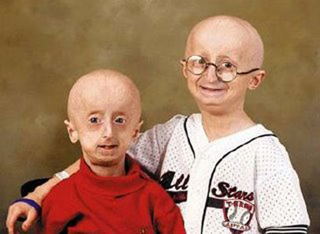 Bệnh Progeria. Progeria là một căn bệnh cực kỳ hiếm gặp, nó khiến cho đứa trẻ mới sinh bị già đi với tốc độ khủng khiếp. Cứ 8 triệu trẻ em ra đời trên thế giới thì một em sẽ mắc phải căn bệnh quái ác này.