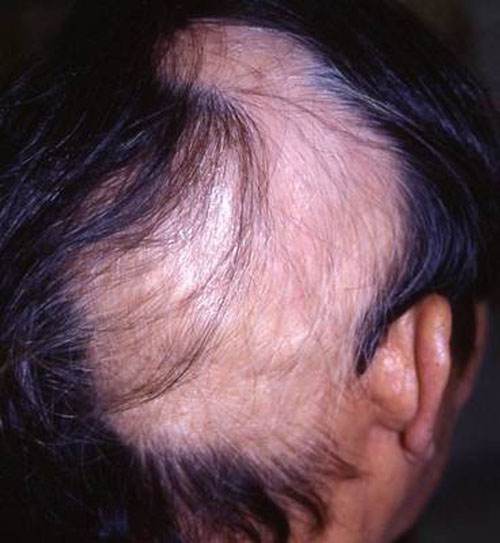 Bệnh Trichotillomania (hội chứng nghiện giật tóc) là một chứng bệnh tâm thần nghiêm trọng xuất hiện ở mọi lứa tuổi. Những tật xấu này khiến tóc ngày một thưa dần và thậm chí bị trọc đầu.