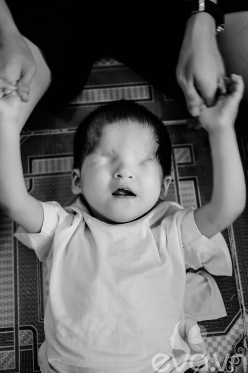 Một em bé bị mù cả hai mắt.