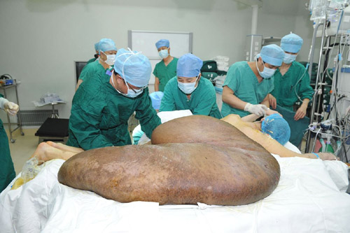 Các bác sỹ đang tiến hành loại bỏ khối u nặng 110kg khỏi cơ thể cho anh Yang Jianbin, 37 tuổi, đến từ tỉnh Sơn Tây, Trung Quốc Trung Quốc.