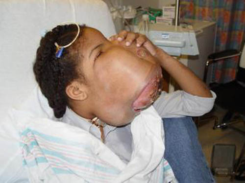 Marlie Casseus sống tại ngôi làng nghèo vùng Haiti. Cô gái 14 tuổi này không thể hít thở hoặc nuốt thức ăn một cách bình thường được bởi khối u lớn tới kinh ngạc trên khuôn mặt.