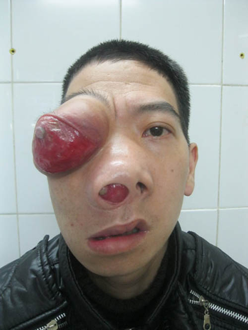 Một chàng trai 28 tuổi người Thái Nguyên, Việt Nam mới đây đã được các bác sỹ của Bệnh viện Saint Paul, Viện Tai Mũi Họng TƯ và Viện Mắt TƯ tiến hành phẫu thuật xử lý khối u quái dị trên mặt.