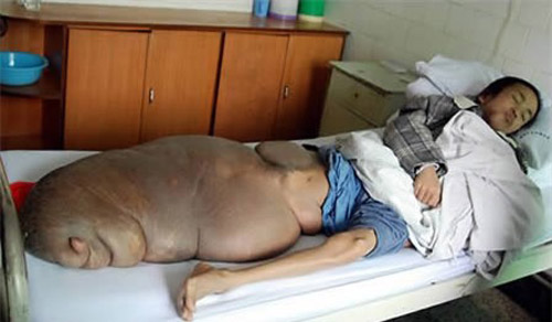Anh Chen Zongtao, 29 tuổi sống tại 1 ngôi làn hẻo lánh và anh còn bị 1 khối u khổng lồ ở chân. Khi mới 2 tuổi, anh có khối u ở chân trái, nhưng sau đó nó lại chuyển sang chân phải, khối u này lớn dần và nó nặng tới 70kg.