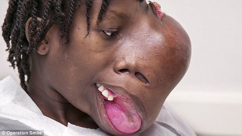 Cô bé Hennglise Dorvial, người Haiti với khối u nặng 1,8kg phát triển từ khoang mũi.