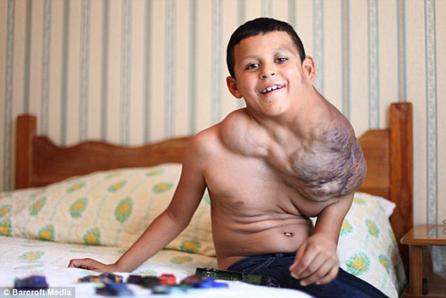 Cậu bé Jose Serrano , 10 tuổi, sống ở Ciudad Juarez , Mexico bị mắc căn bệnh u mạch bạch huyết nên có một khối u khổng lồ ở cổ. Khối u quái ác khiến cuộc sống của Jose gặp vô vàn khó khăn.
