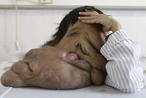 Được coi là Người Voi của Trung Quốc, Huang Chuncai bị biến dạng khuôn mặt nghiêm trọng do hội chứng Neurofibromatosis. Khối u trên mặt anh nặng tới 20kg.