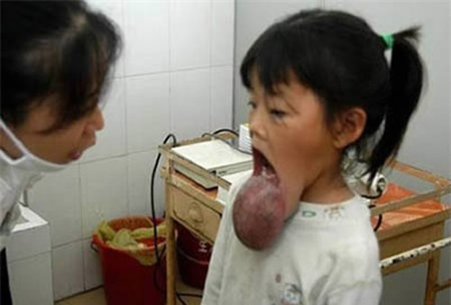 Cô bé 8 tuổi Gao An-ni sống ở An Yuan, tỉnh Jiangxi, Trung Quốc có một khối u ở môi dưới, ngay từ khi sinh ra cô bé đã có khối u này. Do gia đình quá nghèo nên đã không có tiền phẫu thuật cho cô bé.
