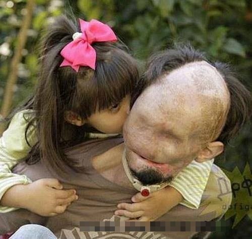 Dù khuôn mặt của cha bị biến dạng vì điện giật, nhưng cô bé Scarlette vẫn hôn lên khuôn mặt và yêu quý người cha của mình.