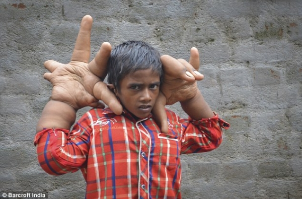 Cậu bé Kaleem (8 tuổi) ở Ấn Độ mắc phải một căn bệnh quái lạ, khiến hai tay cậu sưng to như hai hòn đá tảng. Cậu bé không thể làm được bất cứ công việc tưởng chừng như đơn giản nhất, ngay cả mặc đồ, cài cúc áo hay thậm chí là không thể tự buộc dây giày cho mình.