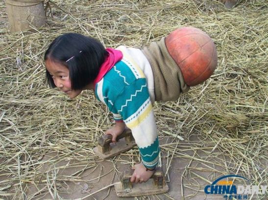 Qian bị mất cả hai chân trong một tai nạn ô tô vào năm 2000. Thay vì mất hy vọng về cuộc sống, cô bé đã lấy một nửa quả bóng rổ úp vào phần dươi thắt lưng và bắt đầu tập đi bằng tay. Qian còn được đặt cho biệt danh là “cô bé bóng rổ”.