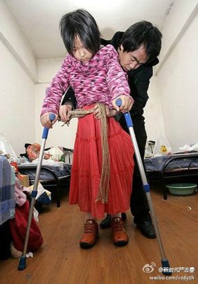 Để có thể bước đi trên đôi chân giả, Qian phải luyện tập rất nhiều tại trung tâm phục hồi.