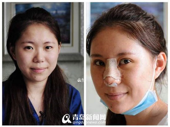 Loạt ảnh công khai phẫu thuật thẩm mỹ của 1 cô gái trẻ người Thanh Đảo, Trung Quốc vừa được chia sẻ trên mạng đã nhanh chóng trở thành chủ đề bàn tán của cư dân mạng.