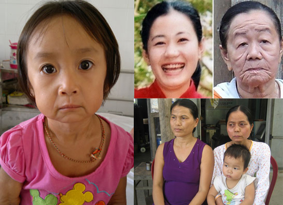 Cận cảnh những khuôn mặt bị lão hóa ở Việt Nam.