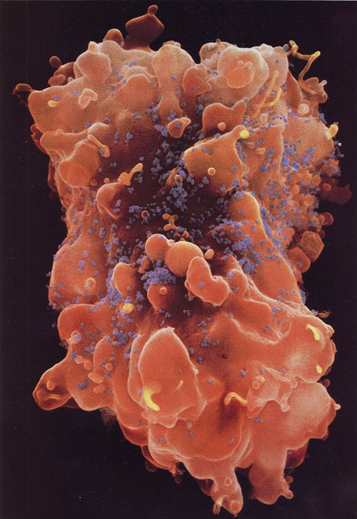 Tế bào T - nơi giữ nhiệm vụ quan trọng trong hệ thống miễn dịch đang bị tấn công bởi virus HIV/AIDS (phần màu xanh).