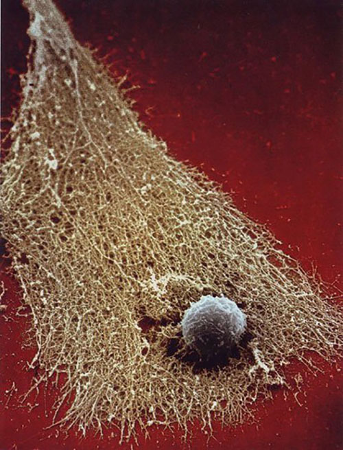 Và đây là kết quả sau trận chiến, tế bào ung thư đã bị phá vỡ và trở thành xơ sau khi đã mất đi tế bào chất.