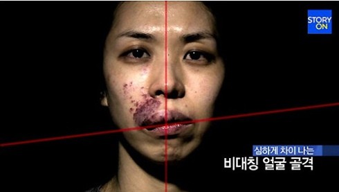 Những bớt đỏ này đã xuất hiện trên gương mặt Kim Hee Eun ngay từ khi lọt lòng do di truyền từ cha, dẫn theo những biến dạng khuôn mặt, răng lợi và cả môi đều bị lệch hàm và sưng tấy, mẩn đỏ.