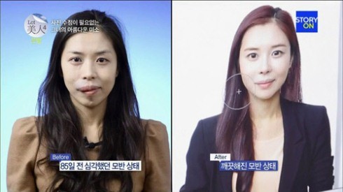 Tham gia vào một chương trình truyền hình thực tế về phẫu thuật thẩm mỹ nổi tiếng ở Hàn Quốc, Kim Hee Eun được chọn làm bệnh nhân tiếp theo được các bác sĩ thẩm mỹ ưu ái và sẽ 'lột xác' cho cô miễn phí.