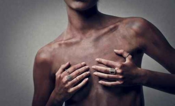 Chỉ cần nhìn những bức ảnh cũng có thể hình dung được 'là ngực' là một quá trình đau đớn và đầy ám ảnh.