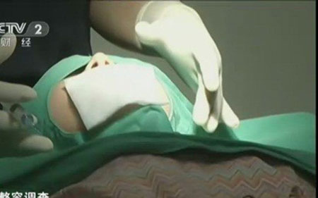 Theo tin tức của đài KBS, cuối tháng 6/2013, một phụ nữ 30 tuổi, người Hàn Quốc đã đến phẫu thuật cằm ở bệnh viện thẩm mỹ Seoul với mong muốn có được một khuôn mặt thon gọn hơn.