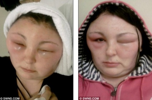 Cô gái này đã phải nhập viện trong tình trạng mắt sưng húp và khuôn mặt…