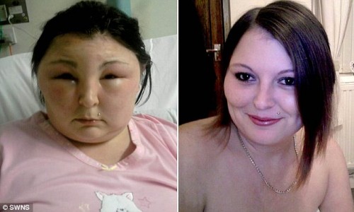 Cô Carmen Rowe, 25 tuổi, sống tại Swansea, Wale, nước Anh đã gặp một sự cố dị ứng bất ngờ sau khi sử dụng thuốc nhuộm tóc.