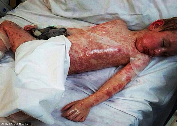 Hình ảnh bé trai tên Ellis Stacey, 5 tuổi, bị dị ứng hiếm với thuốc trị động kinh khiến toàn bộ da trên người của bé nổi những đốm đỏ và bị phồng rộp.
