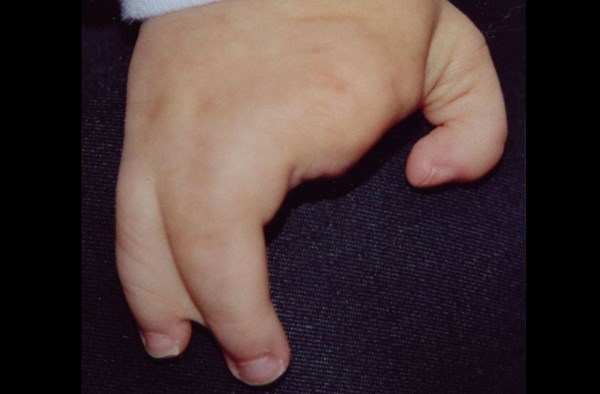 Hội chứng tay càng tôm hùm (Ectrodactyly) là hội chứng mà những người mắc phải bị mất đi một số ngón tay, ngón chân và những ngón còn lại dính vào nhau tạo nên hình dáng giống như càng tôm hùm.
