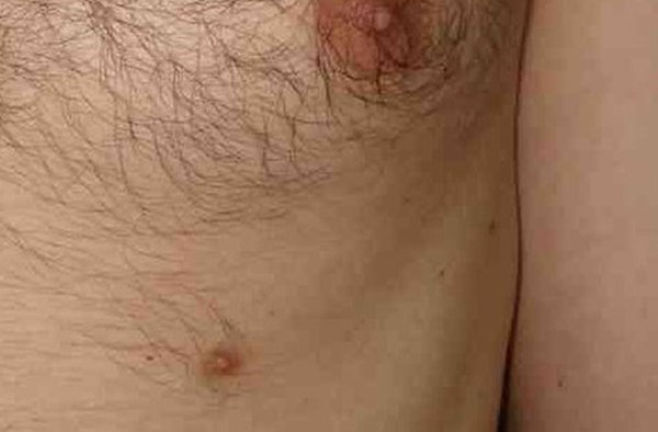 Bệnh thừa núm vú ở nam là tình trạng các vú thừa nằm trên đường vú. Khi có chứa tổ chức tuyến, nó cũng chịu ảnh hưởng của hormon với khả năng chế tiết và khả năng bị các bệnh lý: u tuyến, bệnh Paget.