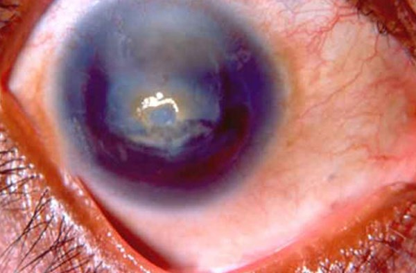 Tật dị mống mắt (aniridia) là một chứng rối loạn di truyền, người mắc phải bệnh này là người hỏng giác mạc bẩm sinh. Bệnh này có thể khiến người đó bị mù và đôi mắt của họ trông rất quái dị.