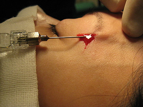Cận cảnh ca phẫu thuật tiêm botox lên phần trán.