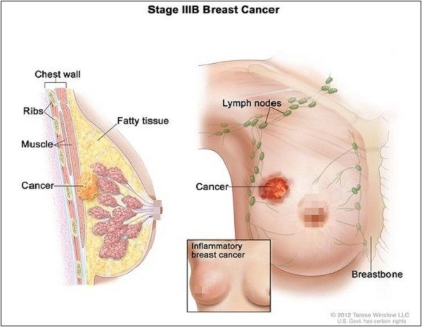 Giai đoạn III chứng kiến tốc độ xâm lấn chóng mặt của các tế bào ung thư. Có thể chia giai đoạn này thành 3 loại nhỏ hơn là IIIA, IIIB và IIIC.