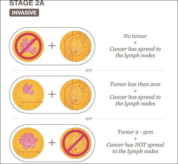 Ung thư nếu tiếp tục phát triển sẽ tiến tới giai đoạn II, gồm IIA và IIB tùy thuộc vào kích thước khối u và sự lây lan của nó.