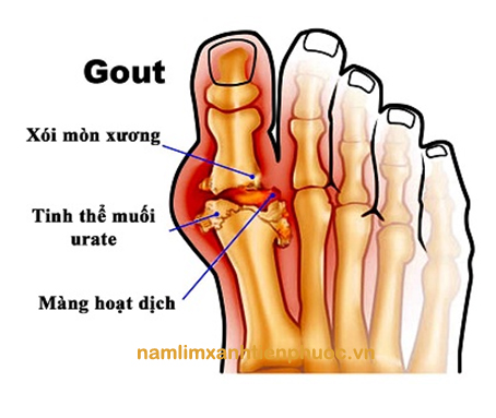 Bệnh Gout(gút), hay còn gọi là thống phong, là thể viêm khớp dạng nặng gây ra nhiều sự đau đớn nhất và có thể có những biến chứng nặng nề.