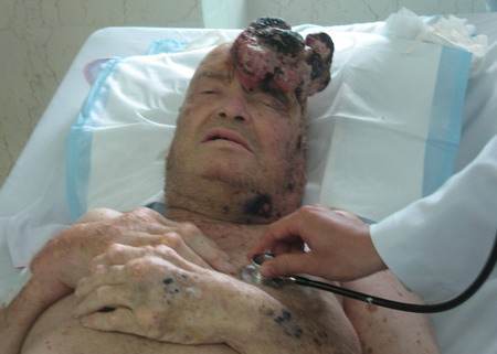 Đây là hình ảnh kinh hoàng của một bệnh nhân gout khi đã đến giai đoạn cuối.